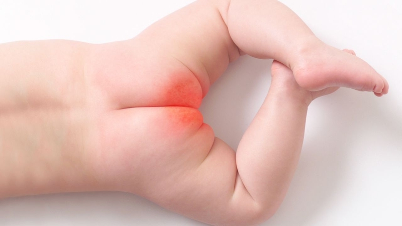 Hăm tã là tình trạng da vùng mặc tã của trẻ bị đỏ, kích ứng